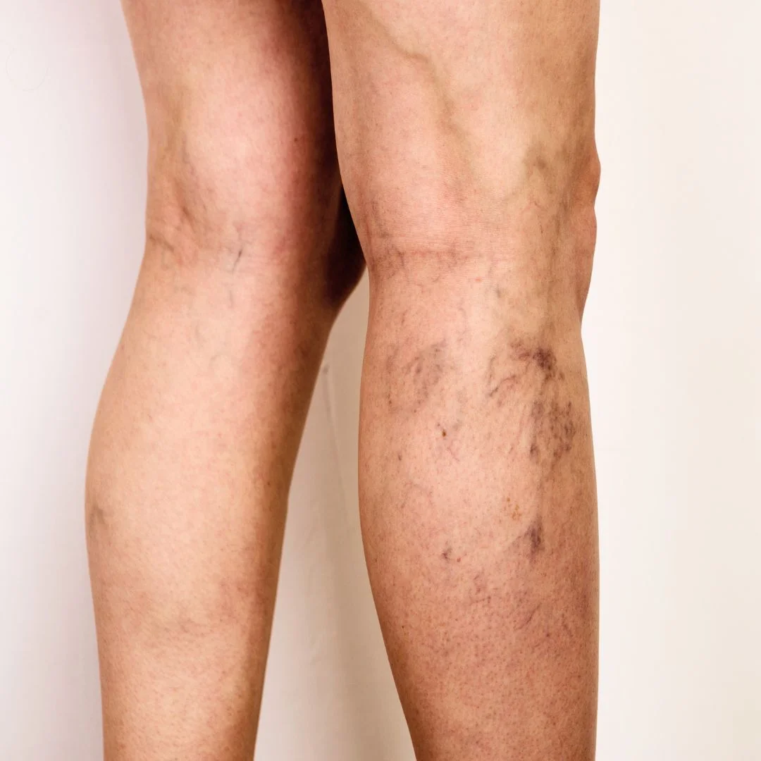 Varicose Vein 1