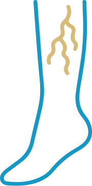 varicose veins