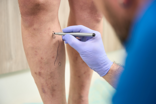 Varicose Vein Treatent