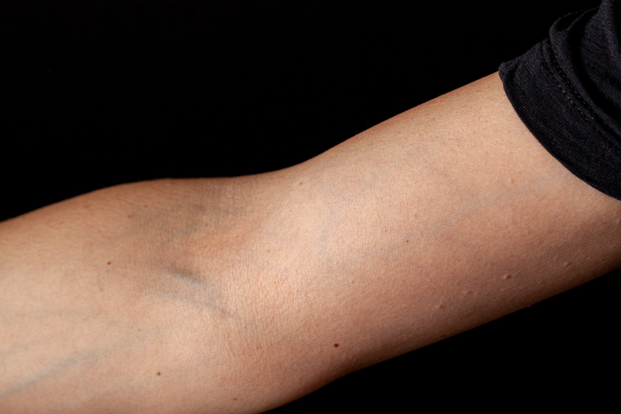 Varicose Veins In The Arm